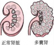 中医专家科普：什么是多囊肾？如何治疗多囊肾